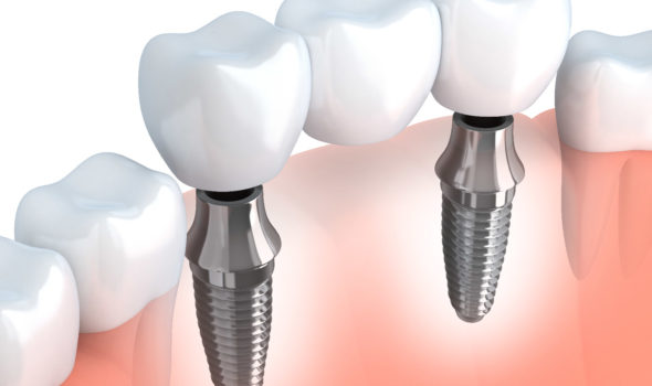 Zubni most na implantatima