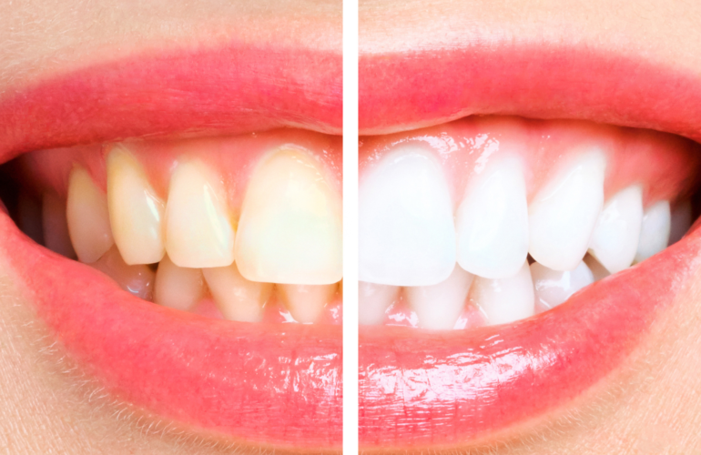 Izbjeljivanje zubi Bjelovar