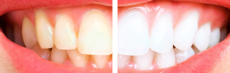 Izbjeljivanje zubi Bjelovar