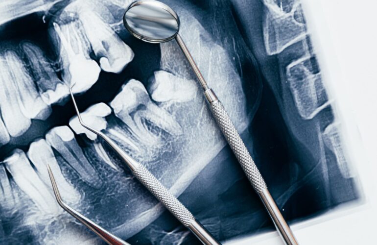 Kako stres utječe na zube