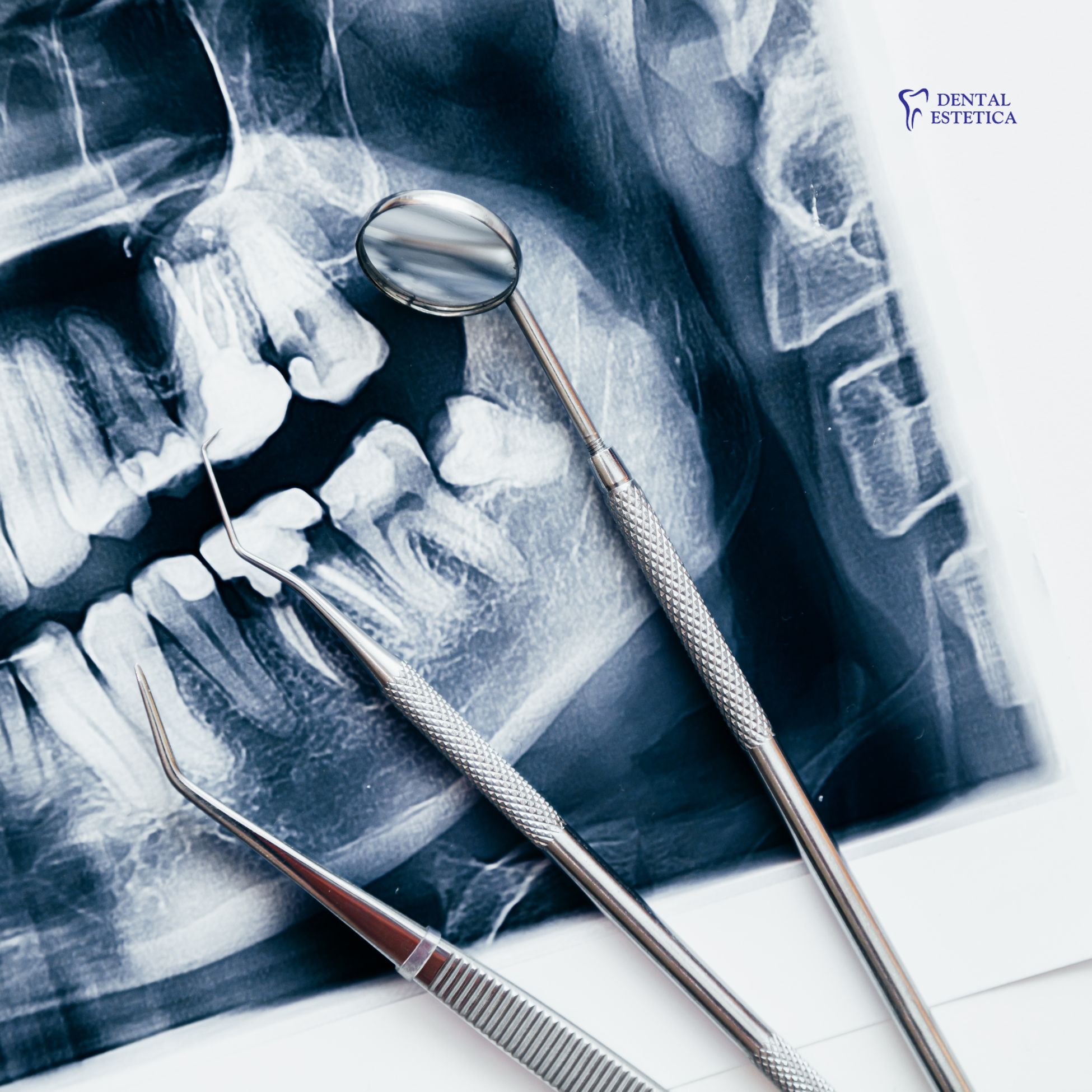 Kako stres utječe na zube